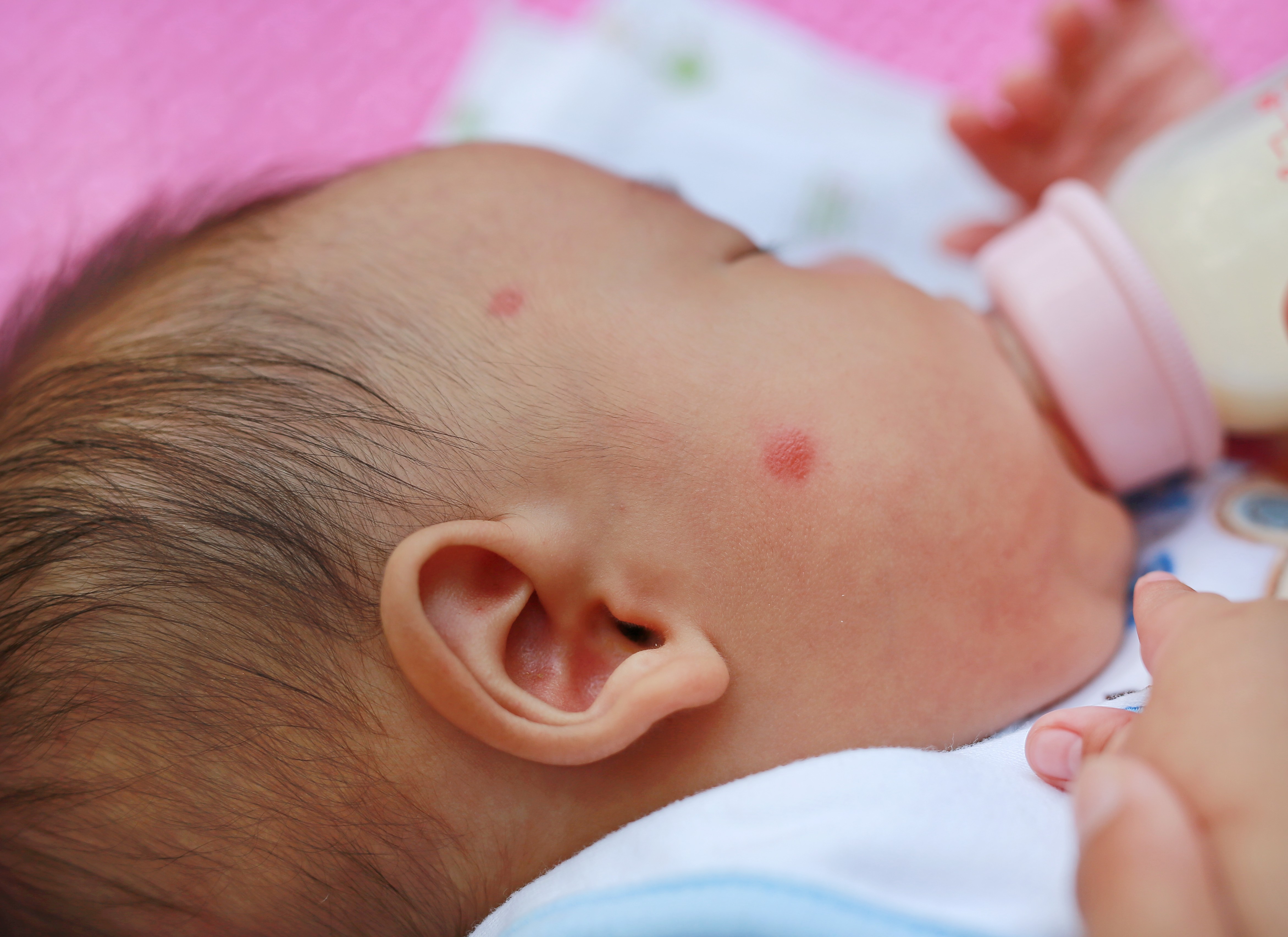 scabies pada bayi, gejala scabies, cara mengatasi scabies bayi, kudis bayi, perawatan kulit bayi, Bunda, si Kecil